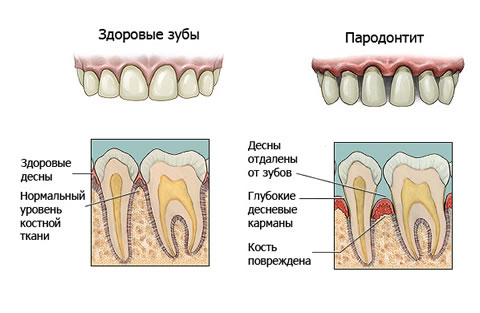 пародонтит схема