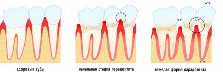 Развитие пародонтита