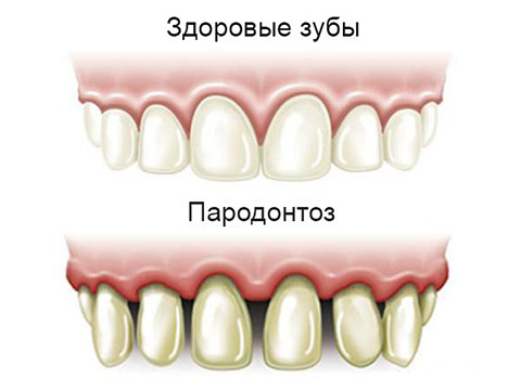 Пародонтоз