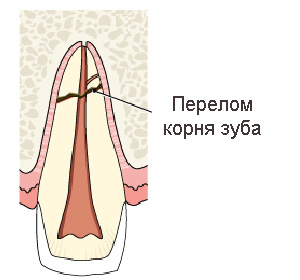 отломом корня зуба