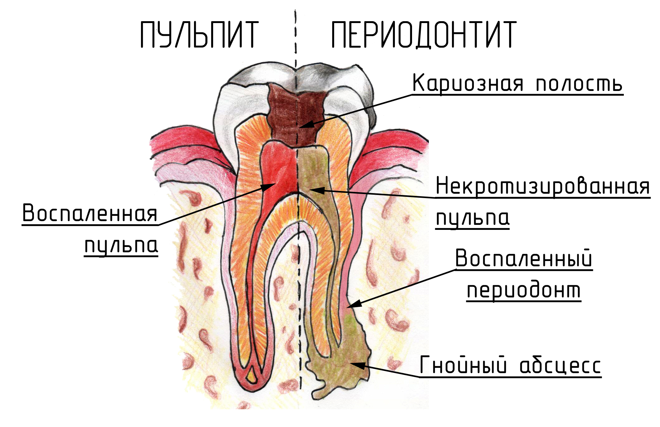 Пульпит и периодонтит