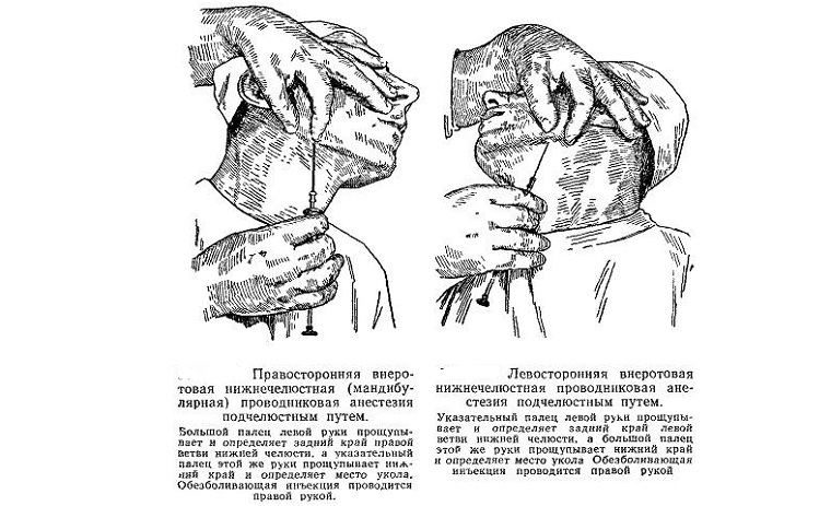 Подчелюстная анестезия