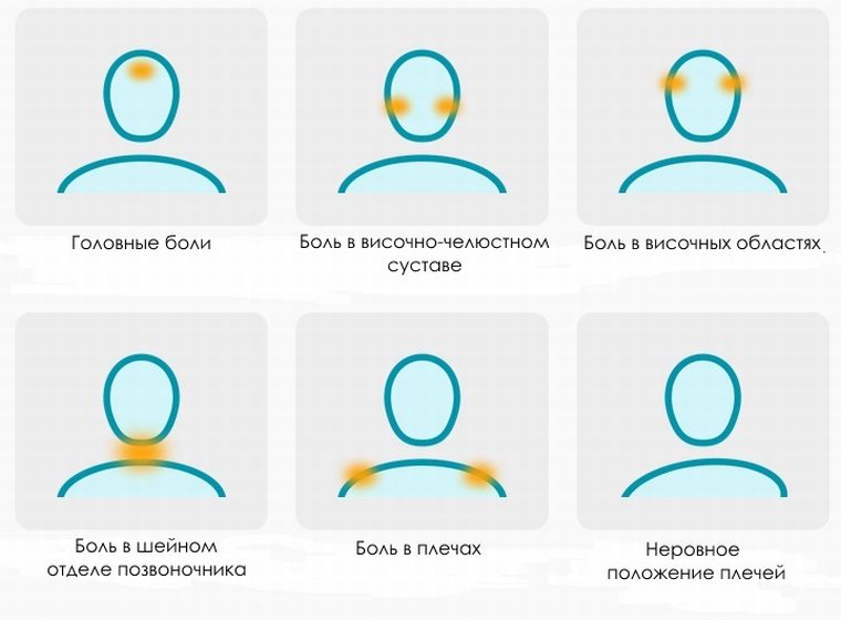 последствия неправильного прикуса