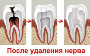 после депульпирования