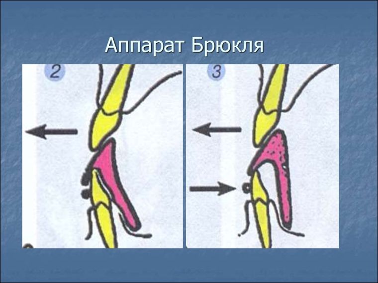 Принцип работы аппарата Брюкля
