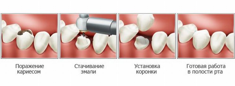 процесс установки коронки