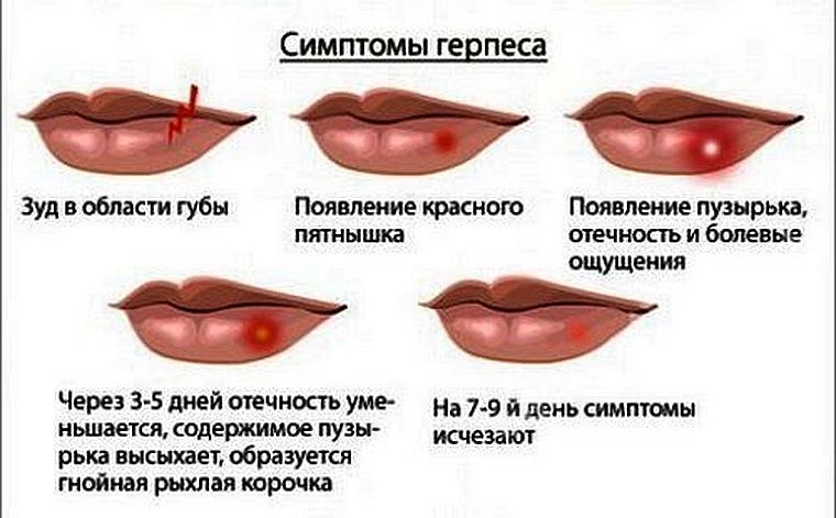 симптомы герпеса