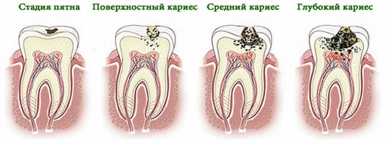 Стадии развития кариеса