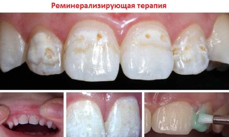 реминерализация зубов