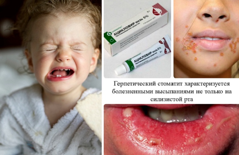 Симптомы вирусного стоматита