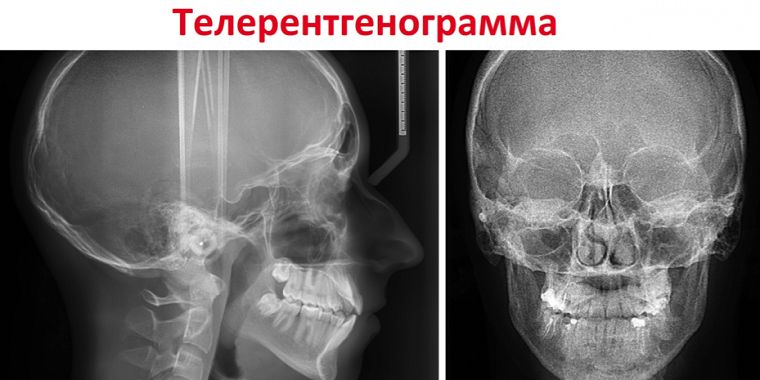 телерентгенограмма
