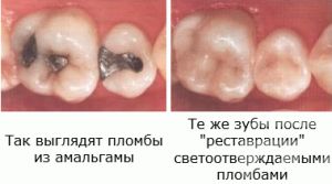 химическая и световая пломба