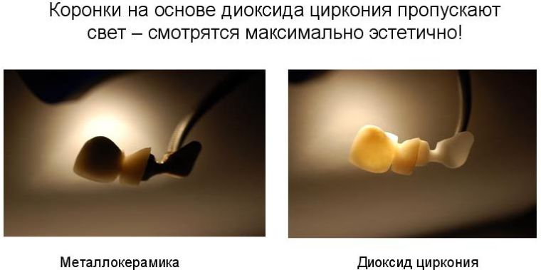 Сравнение коронок