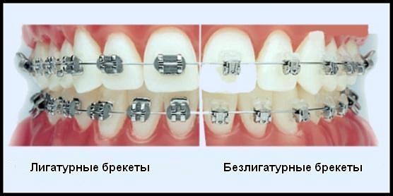 сравнение лигатурных и безлигатурных брекетов