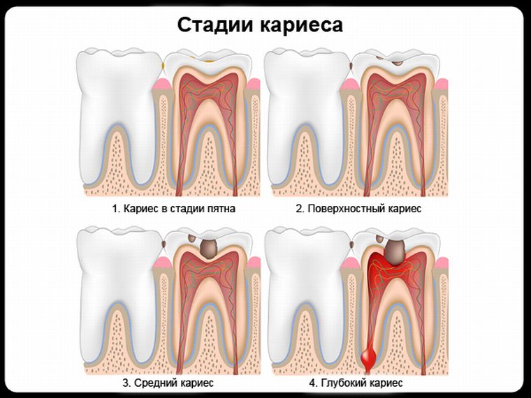 Стадии кариеса