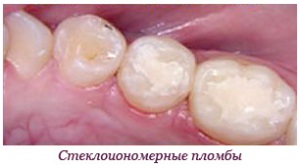 Стеклоиономеры