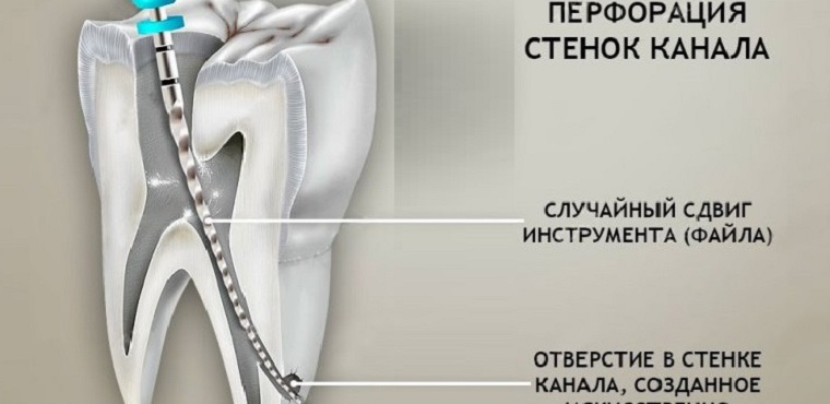Отверстие в стенке зубного канала