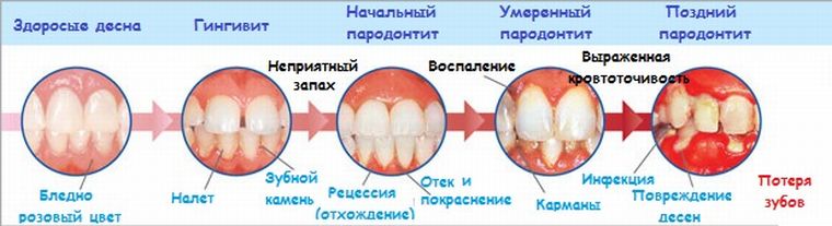 Как развивается пародонтит