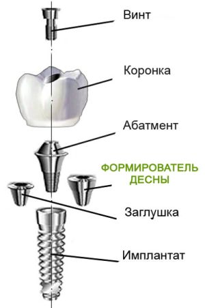 Строение импланта