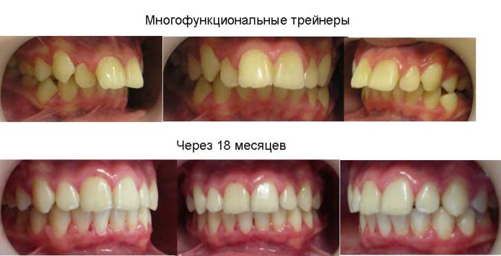 трейнеры фото до и после