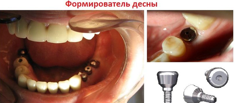 формирователь в десне
