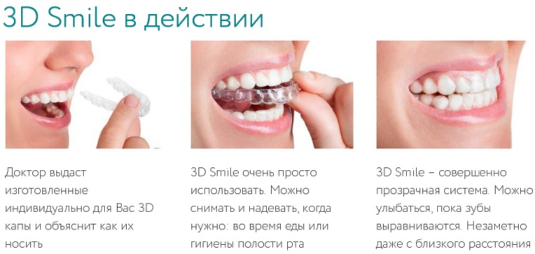Лечение элайнерами