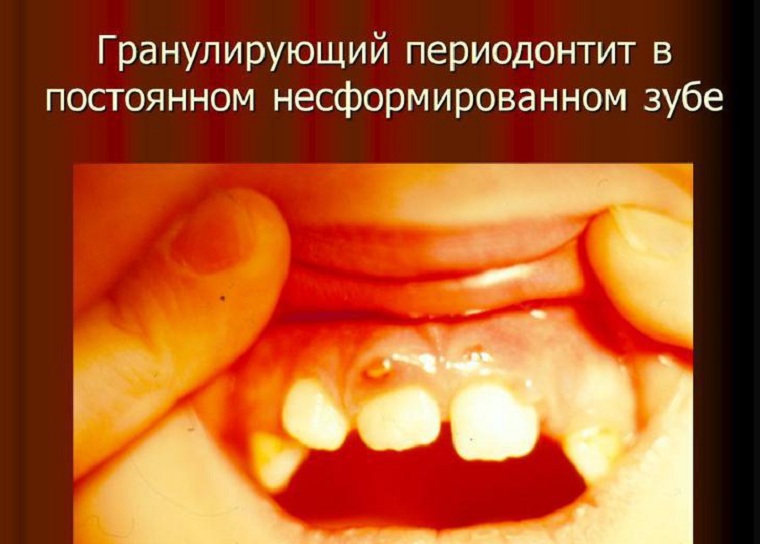 Гранулирующий периодонтит на не сформированном зуба