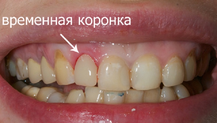 Временная коронка