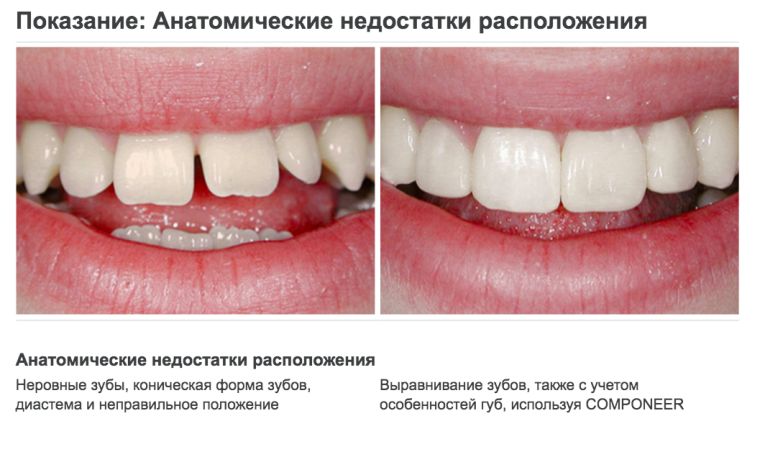 Реставрация зубов компонирами