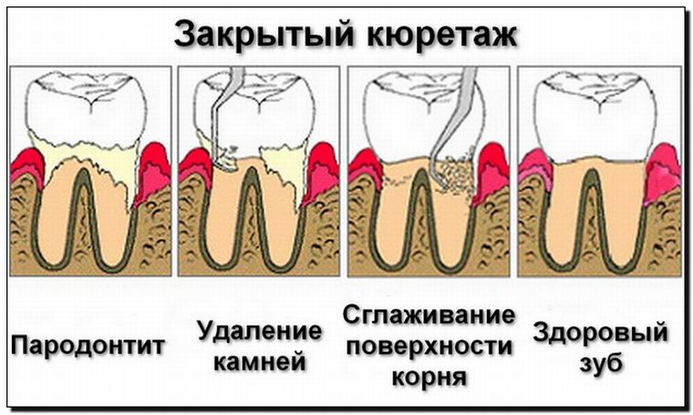 закрытй кюретаж карманов десны