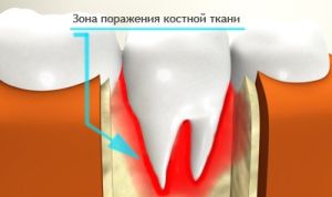 зона поражения